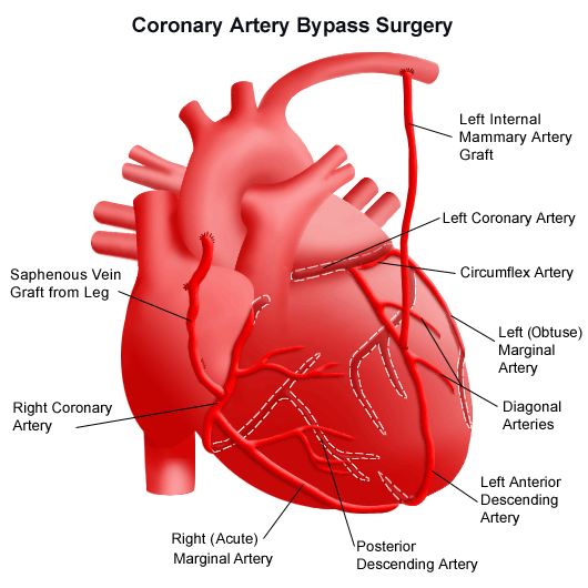 heart disease - Coronary Artery Disease